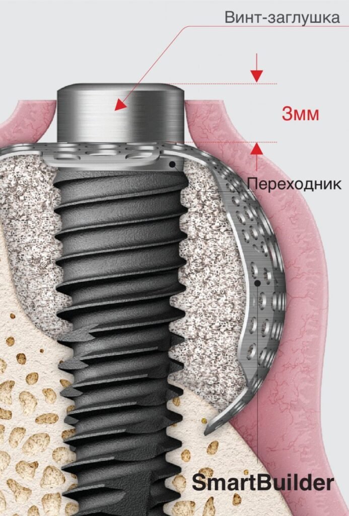 Smart Builder OSSTEM – OSSTEM IMPLANT LEBANON