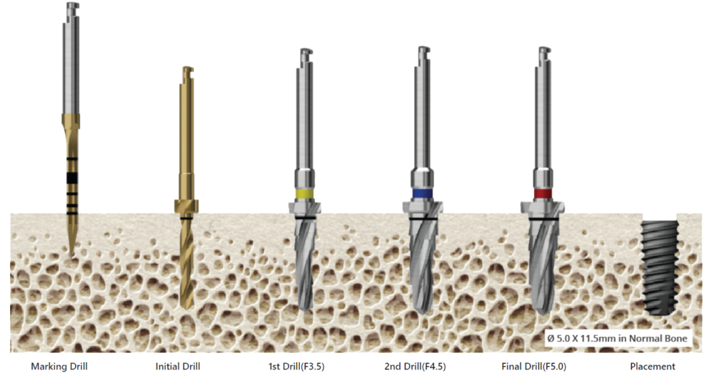 TSIII "SA" OSSTEM IMPLANT - Image 4