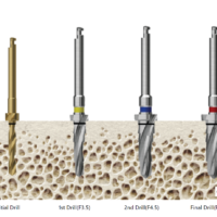 TSIII "SA" OSSTEM IMPLANT - Image 4