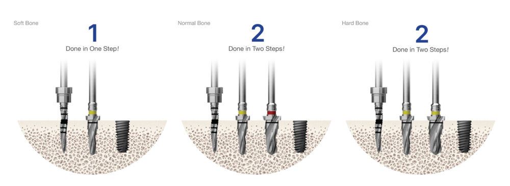 122 TAPER KIT OSSTEM – OSSTEM IMPLANT LEBANON
